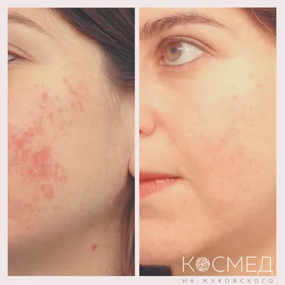 Фототерапия кожи - лечение постакне