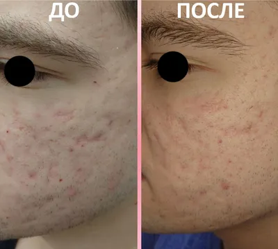 Удаление рубцов, шрамов, постакне. Плазменная шлифовка в Алматы