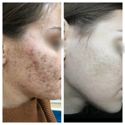 Malina beauty club - Лечение акне и постакне 😱🤩😉 Лазерный карбоновый  пилинг прекрасно решает и эту проблему! Фото вначале лечения и после 3  процедуры!👀‼️ ✓ при таком воздействии лазерного луча уничтожается не