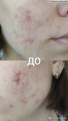 Фотолечение акне и постакне в СПб: цена фототерапии лица на аппарате  IPL-Quantum в клинике косметологии Космед