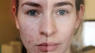 DERMAQUEST » Чем убрать постакне | Статьи | Отзывы | Купить