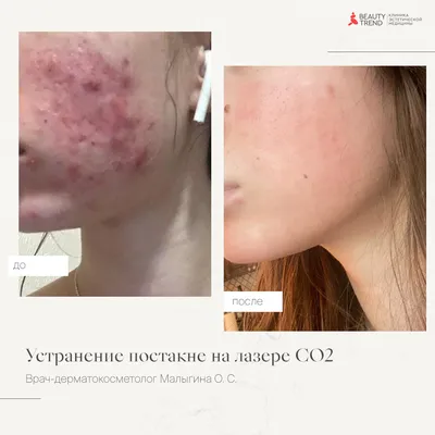 Постакне - лечение и профилактика