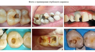 Кариес — причины заболевания, виды кариеса, диагностика и лечение