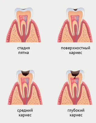 Лечение кариеса всех типов (поверхностный, средний, глубокий)