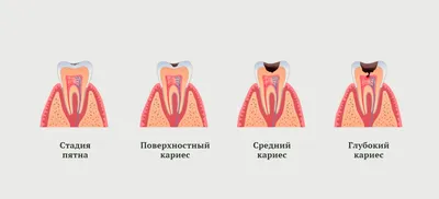 Пришеечный кариес. Диагностика, лечение, профилактика, стадии...