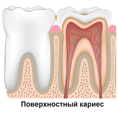 Лечение кариеса зубов, цена в Московской клинике