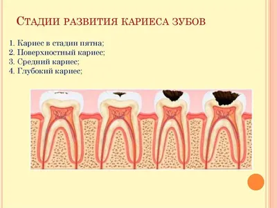 Лечение кариеса | Luxsmile