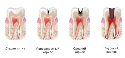 Лечение глубокого кариеса – Вероника