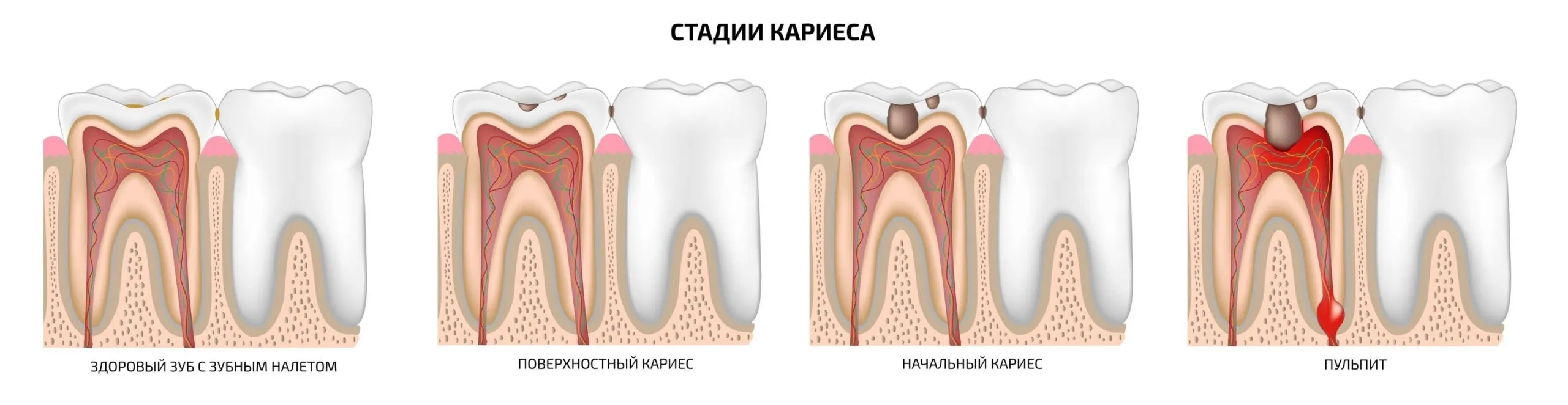 Пульпит Молочных Зубов Фото