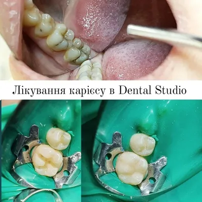 Лечение любых стадий кариеса под контролем DentalPark