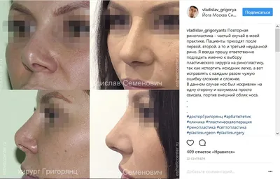 7. Вторичная ринопластика, особенности, факты и примеры — NOSE.AM —  профессиональная ринопластика