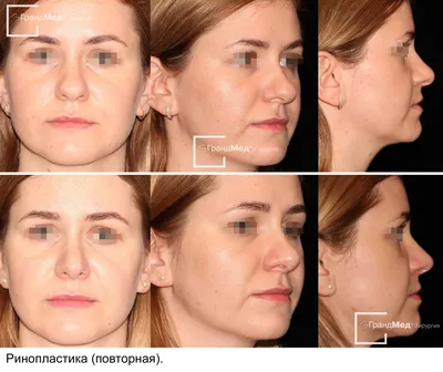 Ринопластика - фото ДО и ПОСЛЕ операции пластика носа | Клиника БИОС
