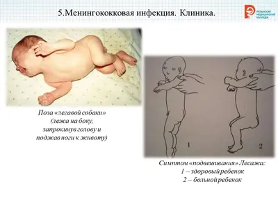 Менингококковая инфекция | Пикабу