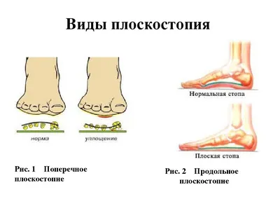 Вальгусная деформация стопы у детей: лечение, причины и симптомы