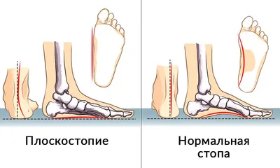 Про анатомию стопы бегуна, плоскостопие и пронацию — Блог «Спорт-Марафон»