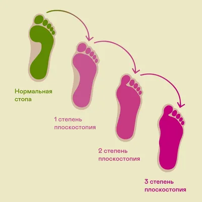 Какими могут быть первые признаки неправильного развития стопы у ребенка? |  ORTHOBOOM - детская ортопедическая обувь | Дзен