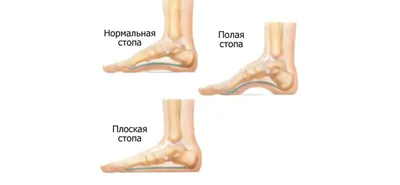 Массаж при плоскостопии у взрослых - Школа мастеров массажа