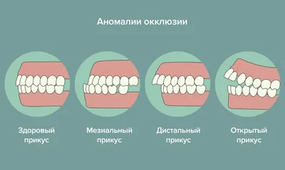 Правильный прикус зубов [какой должен быть прикус, формирование идеальный  прикус]