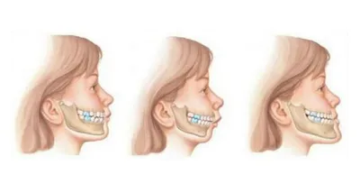 Нормальный прикус — правильное расположение зубов при идеальном прикусе