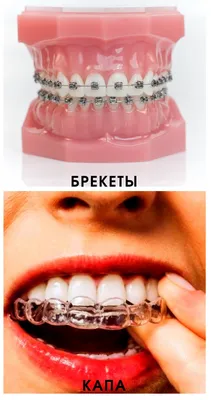 Как исправить неправильный прикус зубов? - Голос українською -  Україна|ЄС|NATO
