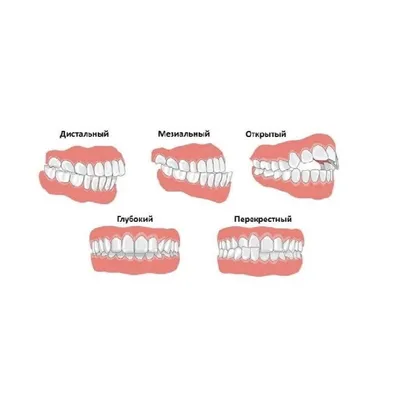 Правильный прикус зубов у человека - как выглядит, как определить, как  сделать