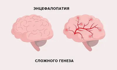 Детский ортопед | травмотолог | Атырау en Instagram: \"✓ЦП. Правосторонний  гемипарез. Плано-вальгусная деформация правой стопы. ✓Проведена операция  артроэрез стопы по Grice. На рентгенограмме после операции видно  восстановление свода стопы ...