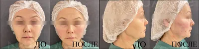 Sculptra (Скульптра) в СПб: цена процедуры в клиниках косметологии NuAnce