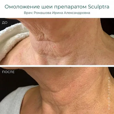 Скульптра – препарат для лифтинга лица и шеи