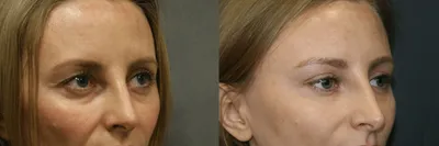 Подтяжка лица SMAS лифтинг: фото во время и после операции | Beauty Insider