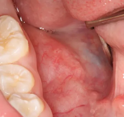 Опухоли мягких тканей полости рта: stsvv — LiveJournal