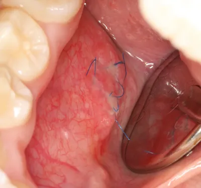 Опухоли мягких тканей полости рта: stsvv — LiveJournal