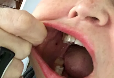 Красное пятнышко внутри щеки - Вопрос стоматологу - 03 Онлайн