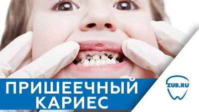 Лечение кариеса — цены в Москве | Damas Medical Center