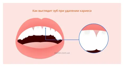 Пришеечный кариес: цена лечения в Электростали в стоматологической клинике