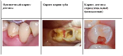 Пришеечный кариес. Диагностика, лечение, профилактика, стадии...