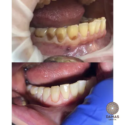 Цена лечения пришеечного кариеса передних зубов в Москве — стоматология  Lotus Dent