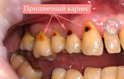 Лечение пришеечного кариеса зубов в Москве | Стоматологическая клиника  «Лаки Смайл»