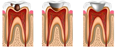 Лечение глубокого кариеса на жевательном зубе: выполненная работа с фото до  и после в стоматологии OneDent