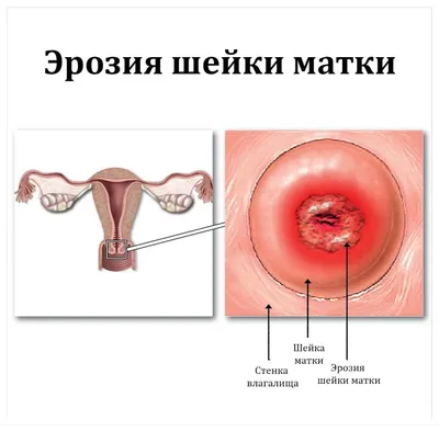 Выделения после прижигания эрозии шейки матки: врач в Москве.