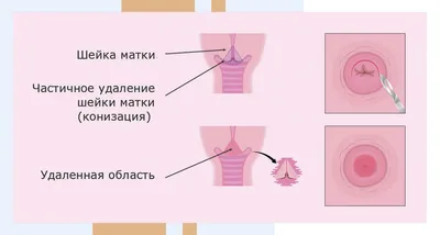 Эрозия шейки матки: симптомы и лечение в Ростове-на-Дону