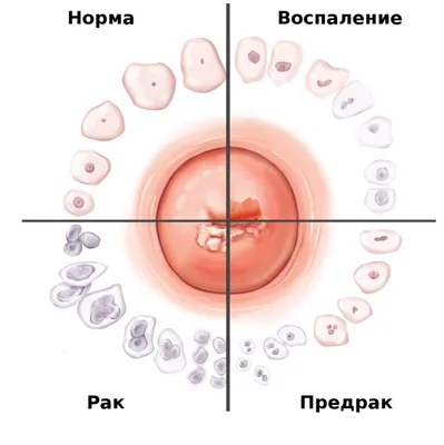 Лечение эрозии шейки матки, в т.ч радиоволновое в Челябинске