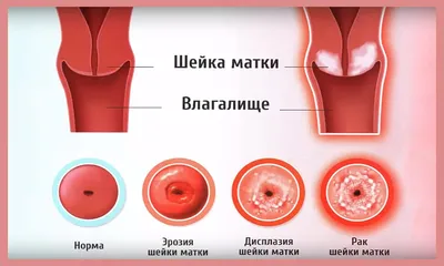 Эрозия шейки матки: симптомы, причины и лечение | Real Clinic -  многопрофильный медицинский центр и косметология | Дзен