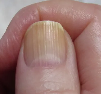 Бороздки на ногтях: продольные / вертикальные / поперечные | Причины |  Лечение борозд на руках / ногах в Москве в Клинике подологии Полёт