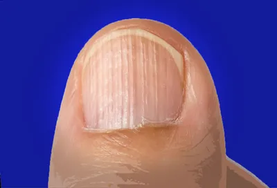 Продольные борозды на ногтях - что это и как лечить