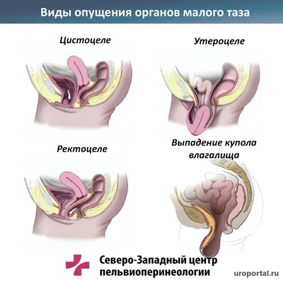 Опущение органов малого таза (Пролапс тазовых органов)