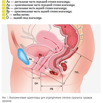 Пролапс уретры у женщин | ЦЕНТР УРОЛОГИИ И АНДРОЛОГИИ