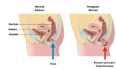 Genital prolapse and urinary incontinence: therapy options - Dobrokhotova -  Consilium Medicum