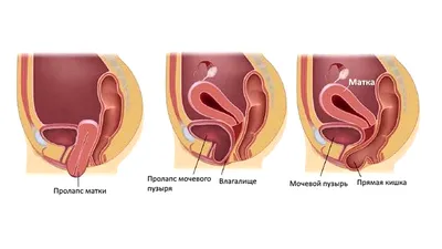 Пролапс тазовых органов