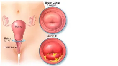 Опущение влагалища и матки - пролапс гениталий