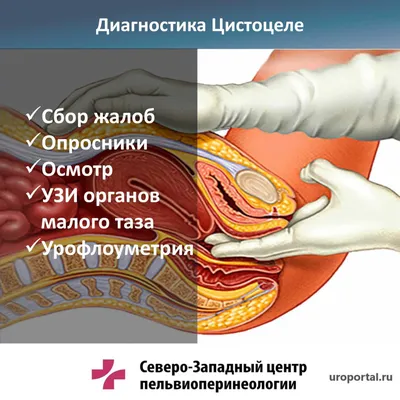 Что такое пролапс мочевого пузыря? Каковы симптомы и лечение?